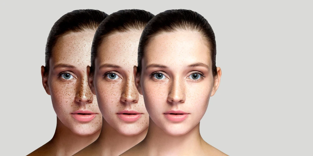 Young lady with Dark Patches and Brown Spots on face