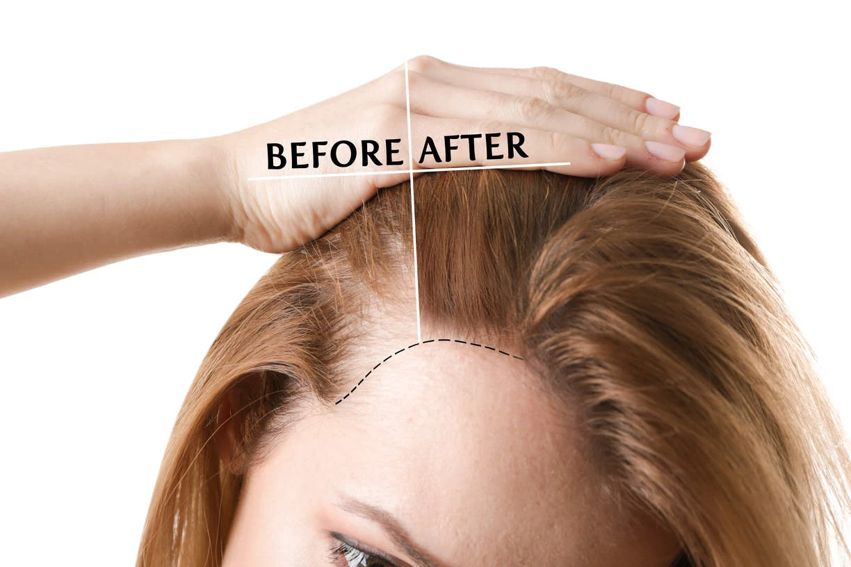 Young lady before and after applying hair loss treatment