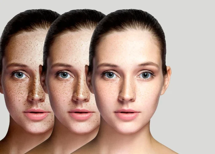 Young lady with Dark Patches and Brown Spots on face